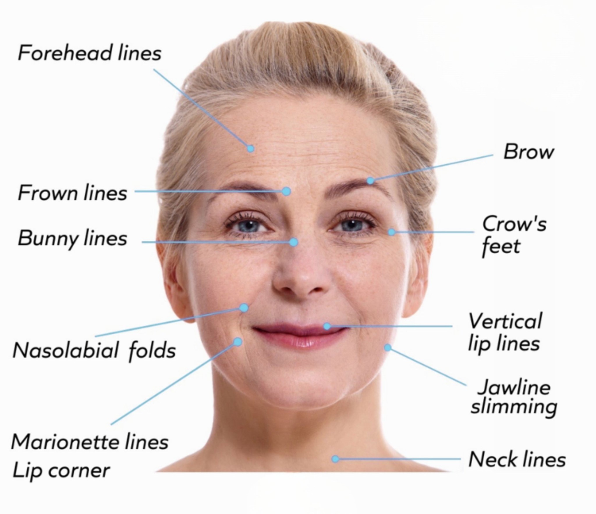Area of Botox Treatment
